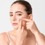 Sofranızdaki gizli tetikleyiciler cilt bariyerinizi bozuyor olabilir: Akne problemini tetikleyen 7 besin – Son Dakika Yaşam Haberleri