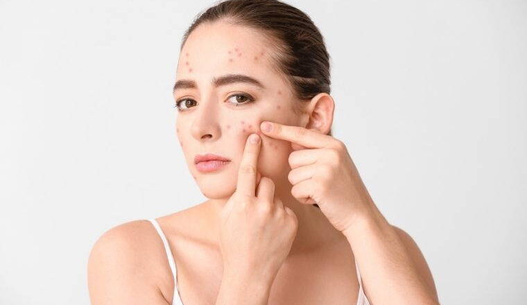 Sofranızdaki gizli tetikleyiciler cilt bariyerinizi bozuyor olabilir: Akne problemini tetikleyen 7 besin – Son Dakika Yaşam Haberleri